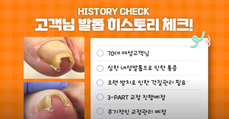 70대 심한 내성발톱 관리