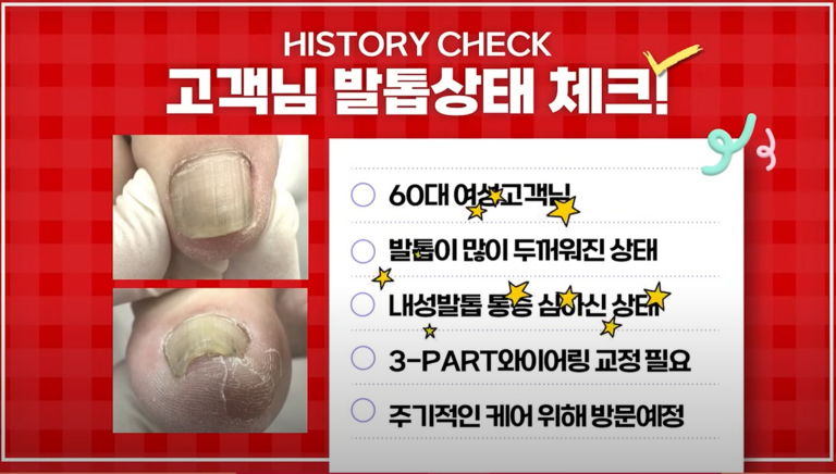 내성발톱 통증이 심한 어머님 발톱 교정
