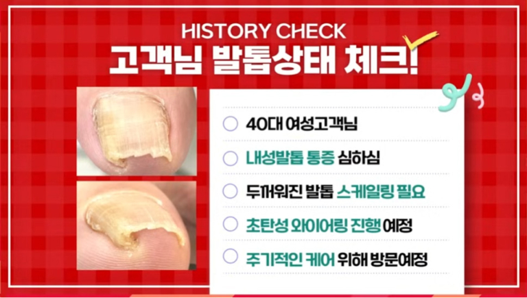 40대 고객 내성발톱