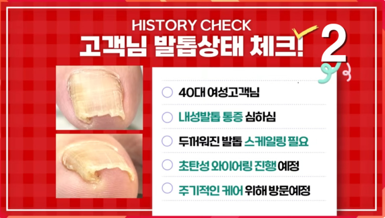 후크선장 갈고리 내성발톱 관리 2탄