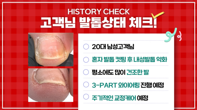 20대 남자 내성발톱