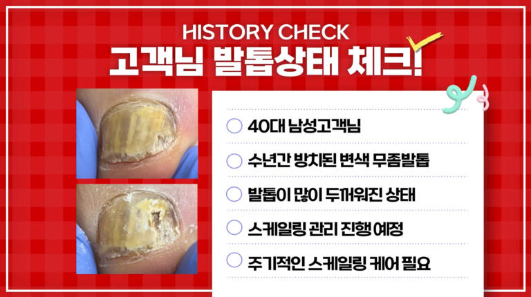 40대남성발톱무좀