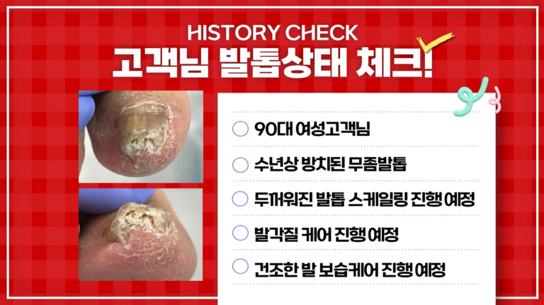 90대어머님 무좀발톱