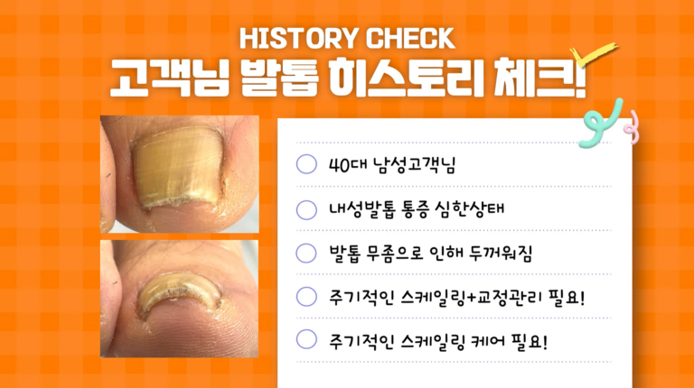 걷기도힘든내성발톱