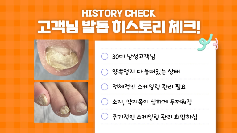 들떠있는 발톱