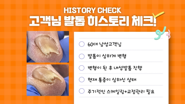 심하게 변형된 내성발톱