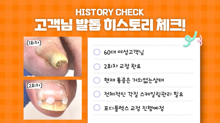 집게 내성발롭