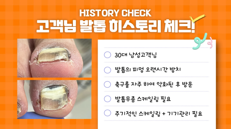 축구 발톱